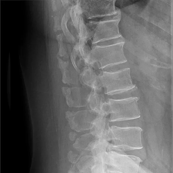 X-RAY LUMBER SPINE LATERAL VIEW
